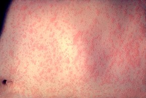 290px-Morbillivirus_measles_infection